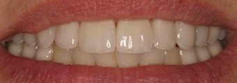Porcelain Veneers
