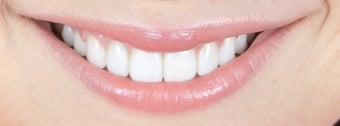 Gum re-contouring and porcelain veneers