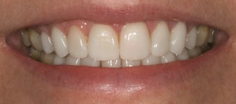 Porcelain crowns and porcelain veneers