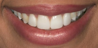 Porcelain veneers