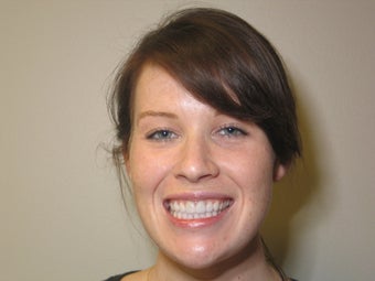 2 Porcelain Veneers