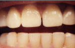 Porcelain Veneers