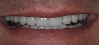 Full mouth dental reconstruction