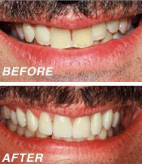 Dental Veneers