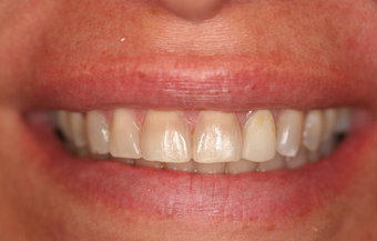  Porcelain Veneers Smile Makeover
