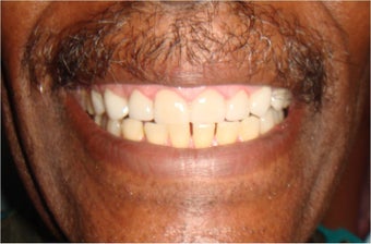Veneers