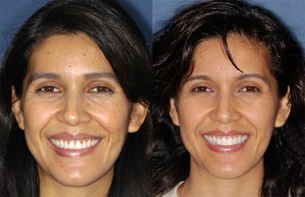Four veneers and whitening