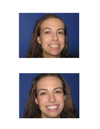 Upper  Procelain Veneers