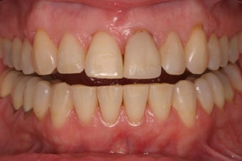 Veneers
