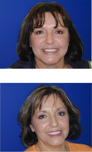 Cosmetic Dentistry- Upper Veneers and Teeth Whitening