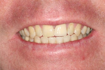 Porcelain Veneers/ Smile Makeover
