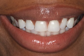 Durathin Minimal Prep Veneers
