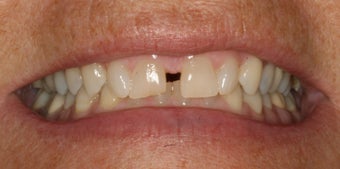 Smile Makeover