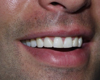 Veneers