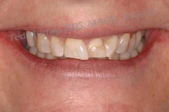 Smile Makeover with Porelain Veneers and Crowns