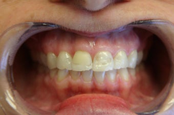 6 veneer