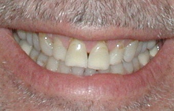 Porcelain Veneers