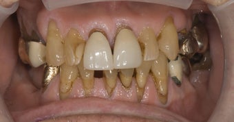 parcelain crowns and veneers