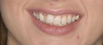 porcelain veneers
