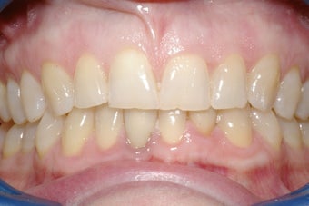 Porcelain Veneers four front teeth