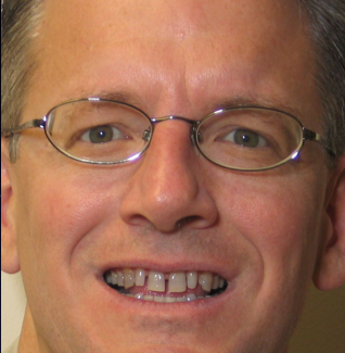 Porcelain Veneers