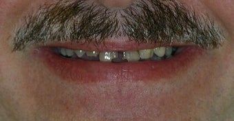 Porcelain Crowns and Veneer