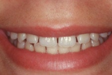  Porcelain Veneers