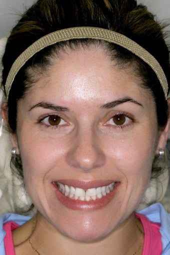 Eight porcelain veneers on upper teeth closing midline space.