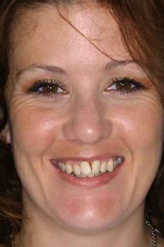 Smile Makeover With Porcelain Veneers