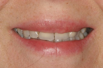 Temporary Veneers
