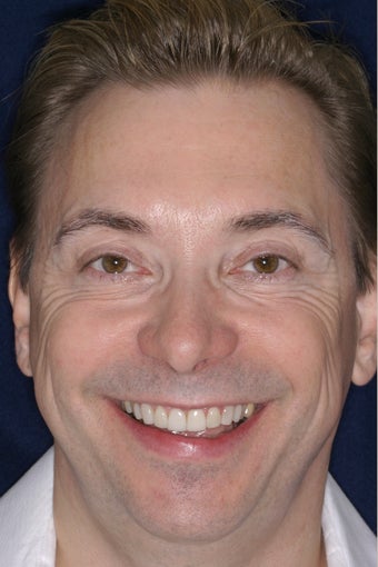 Porcelain Veneers