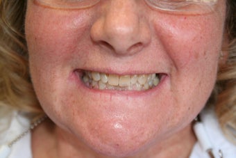 Smile renewal