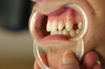 porcelain bridge with veneers replacing teeth