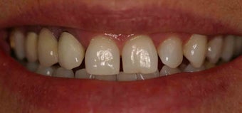 Porcelain Veneers and Crowns