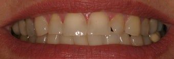 Porcelain Veneers
