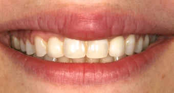 Gum re-contouring and porcelain veneers