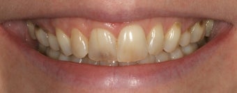Porcelain crowns and porcelain veneers