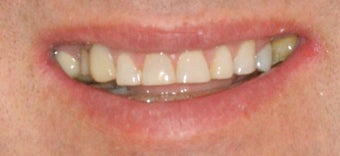Porcelain crowns and porcelain veneers