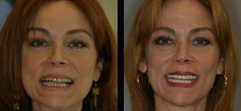 Smile Makeover with Veneers