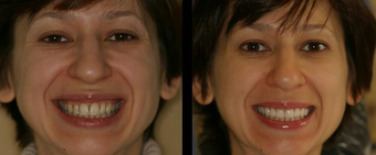 Smile Makeover with Veneers