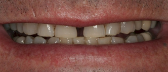 Full mouth dental reconstruction