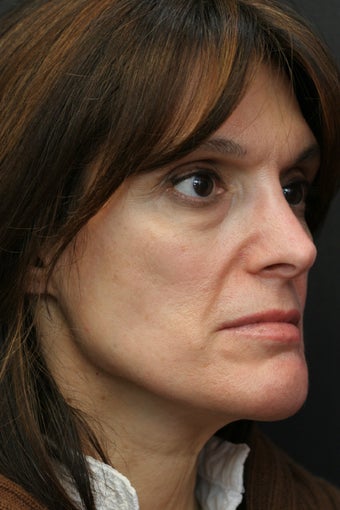 Portrat PSR3 Plasma Skin Resurfacing