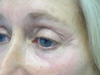 Portrait Plasma Resurfacing