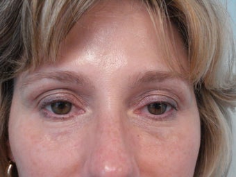 "No-Lift" Eye Lift with Portrait PSR and Filler Injection