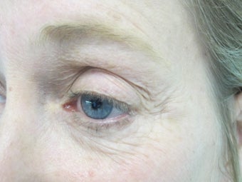 Portrait Plasma Resurfacing