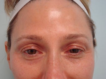 "No-Lift" Eye Lift with Portrait PSR and Filler Injection