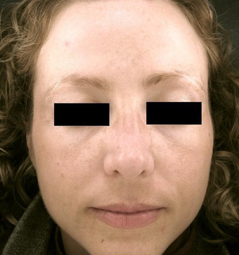 Pro-Fractional plus Chemical Peel