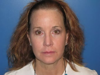 Microlaser Peel, Profractional Laser, and Broad Band Light treament