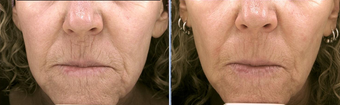 Pro-Fractional Laser
