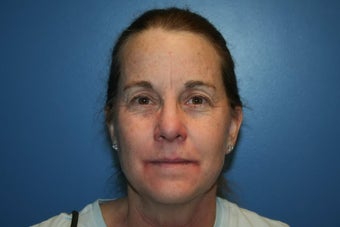 Microlaser Peel, Profractional Laser, and Broad Band Light treament